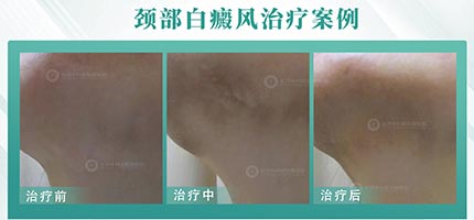 7岁孩子患白癜风，在中科3月后白斑消退