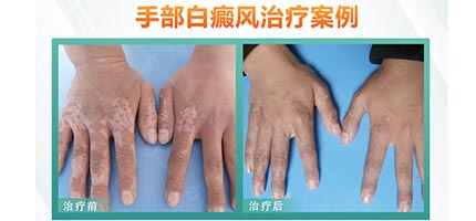 17岁孩子患白癜风